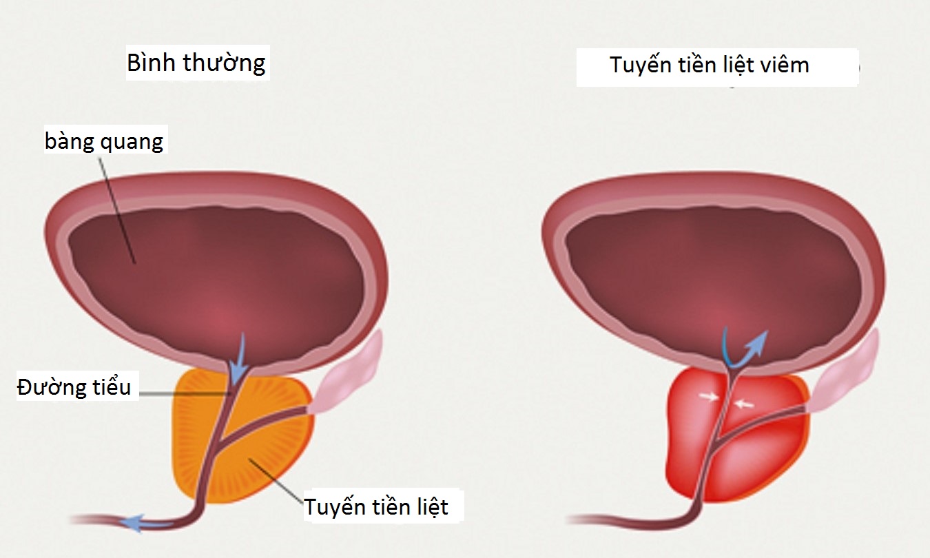 Nam giới đã biết hết quy trình xét nghiệm viêm tuyến tiền liệt chưa