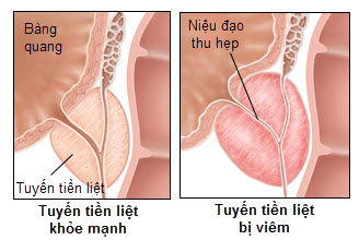 Truy tìm các yếu tố làm tăng nguy cơ viêm tuyến tiền liệt ở nam giới