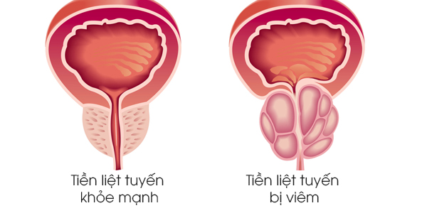 Thông tin đầy đủ và chính xác nhất về tìm hiểu bệnh viêm tuyến tiền