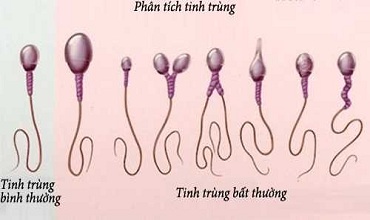 những nguy hại của tinh trùng bất thường gây ra