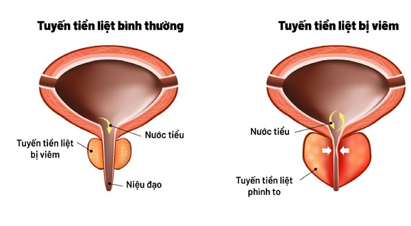 Mách nam giới cách chữa viêm tuyến tiền liệt cực hiệu quả