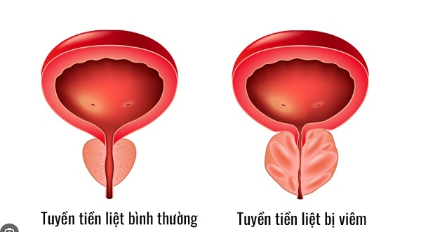 Phát hoảng với những ảnh hưởng của bệnh viêm tuyến tiền liệt