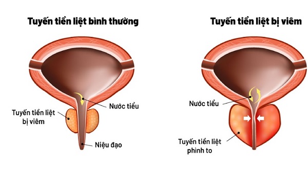 Nam giới cần hiểu rõ thế nào là bệnh viêm tuyến tiền liệt?