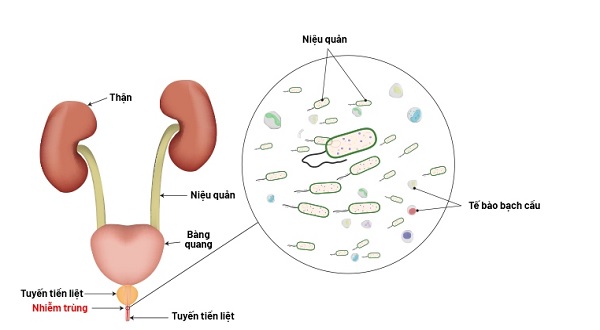 Cùng các chuyên gia tìm hiểu viêm niệu đạo ở nam