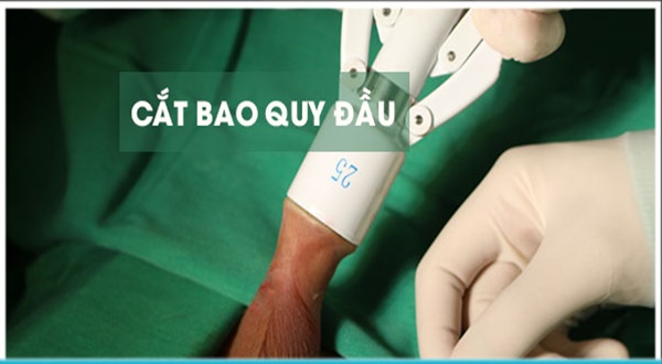 Có nên cắt bao quy đầu truyền thống hay không? Bác sĩ giải đáp chi tiết