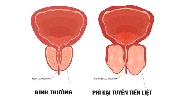 Bệnh phì đại tiền liệt tuyến và những thông tin cần biết