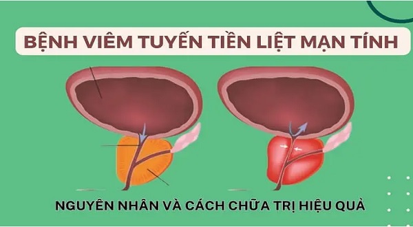 Triệu chứng viêm tuyến tiền liệt mãn tính và cách xử lý hiệu quả