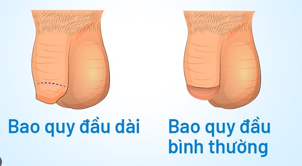 Nam giới bị bao quy đầu dài có cần cắt không?